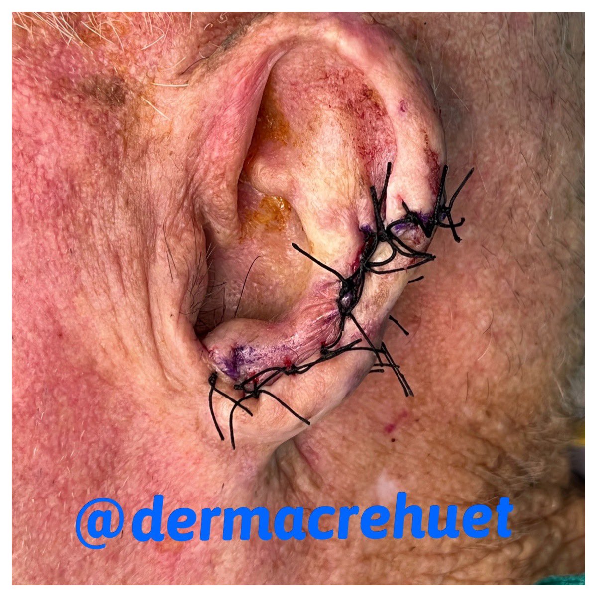 New #surgery! #ear #helix reconstruction after large #SquamousCellCarcinoma removal. Advancement #flap was our choice this time #dermatology #oncology #nonmelanomaskincancer #skin #carcinoma #CordobaEsp