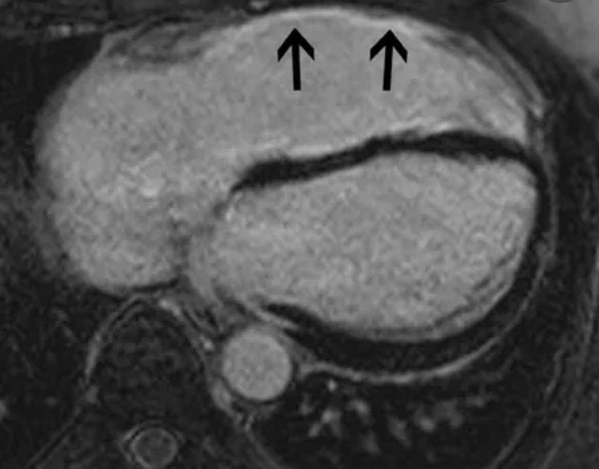 radRounds's tweet photo. 56 year old construction worker fell off ladder unconscious. What happened and what is ##cardiac #MRI of #heart showing? #meded #MedTwitter #hcldr #physician #radiology #radiologist #cardiology #CardioTwitter #medschool #MedStudentTwitter #futureradres #futureres https://t.co/Dp6OsC3mi4