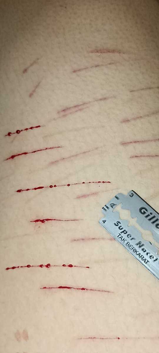 ZarithAlberich's tweet photo. //tw// selfharm , self harm , shtwt , cuts , barcodetwt 
First day trying on razor blade. I usually use pencil knife but razor blade cuts are just *chef kiss* https://t.co/jbUKKswZPZ