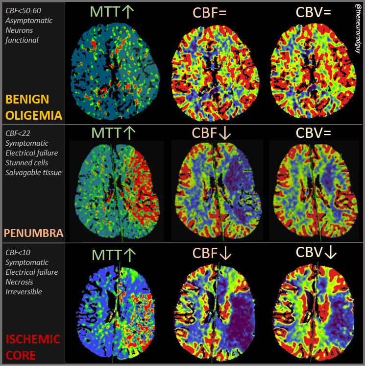 chrost_hugo's tweet photo. Basic perfusion-CT patterns, nicely coloured perfusion-maps
By @theneuroradguy
#neuroscienc #science #sciencetwitter #neurotwitter #bioinformatics #biochemistry #prefusion #medtwiter #stroke #RadEd #MedEd #FOAMed #FOAMrad https://t.co/xoLlO7Ktmj
