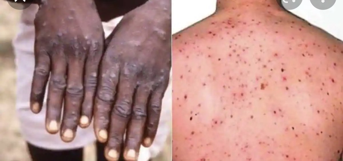 NYC reveals that 95% of monkeypox
patients in the Big Apple are men
mol.im/a/11018731 via dailym.ai
androidحتي الان لا يعرف لماذا ٩٥٪؜ من جدري القرود منتشر بين المثليين الرجال في مدينة نيويورك