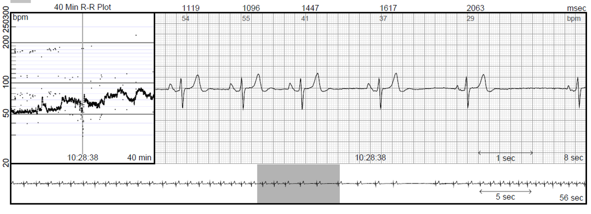 Toaster_Pastry's tweet photo. All Holter monitors are not alike. 2 different cardiac rhythm patch monitors from 2 companies, at different times, note 2 p-wave morphologies (look at last 2 beats on left figure). Monitor on the left has a much better signal fidelity. Monitor on right change is barely seen. https://t.co/C1mC29PGXI