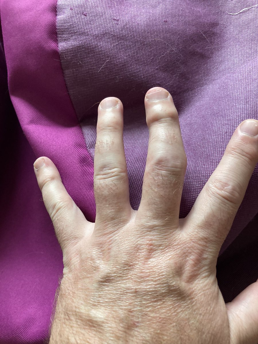 AJR410's tweet photo. @_thewkcoach Left middle finger- guaranteed every season! https://t.co/Y5fpDVx1qZ