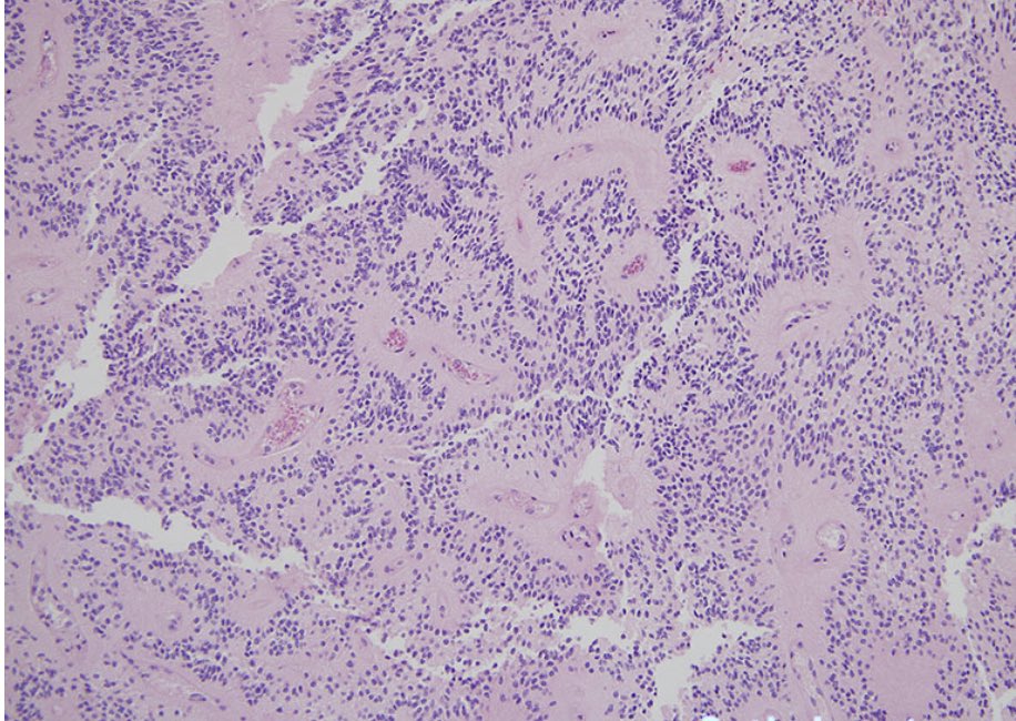 Who Am I ? #PathTwitter #neuropath #pathology #ssmc 
I am a brain tumor that is usually well circumscribed. I am Olig 2 negative with dot like positivity of D2-40 and EMA. Who am I ?
