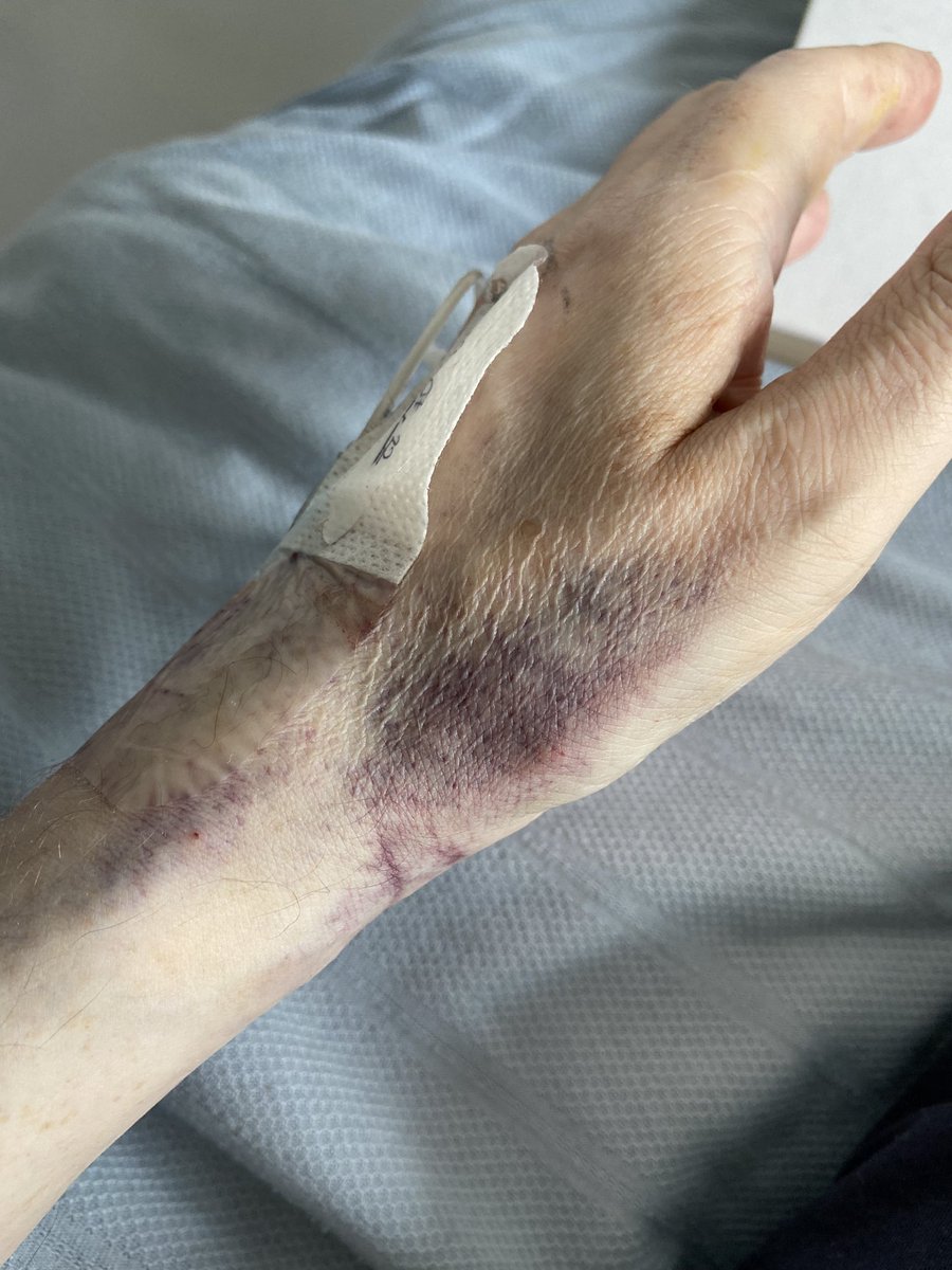 CitizenDoov's tweet photo. One month in hospital and the hands aren’t fairing to well https://t.co/2d6Kpt3z8g
