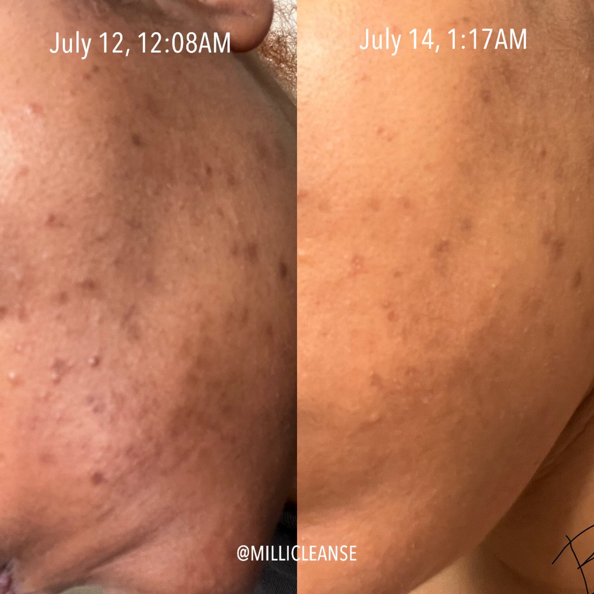 MilliCleanse's tweet photo. This is only 2 uses of Milli’s MudMask! 🔥⏰ THE DIFFERENCE ALREADY… https://t.co/5sQF6rXKxu