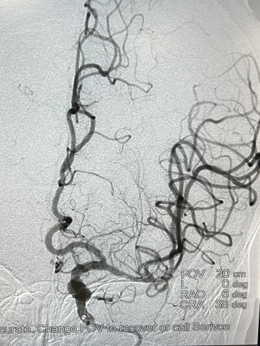 Thrombectomy by TRA approach.
#radialforneuro #radialfirst