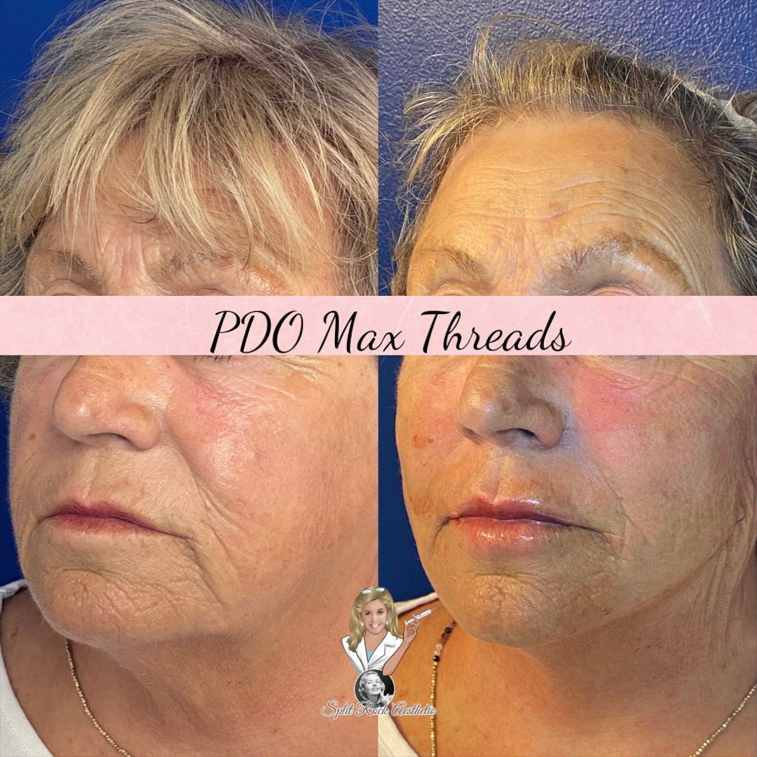 SplitRockAesIns's tweet photo. ✨PDO MAX Glow up!✨

A minimally invasive procedure to tighten and lift your skin!

Split Rock Aesthetic Institute
☎️ (203) 831-8029
📧 info@Lisatopham.com
💻 https://t.co/B0a4cGiCjH
Greenwich, CT &amp; Wilton, CT https://t.co/nE6G8a6NjJ