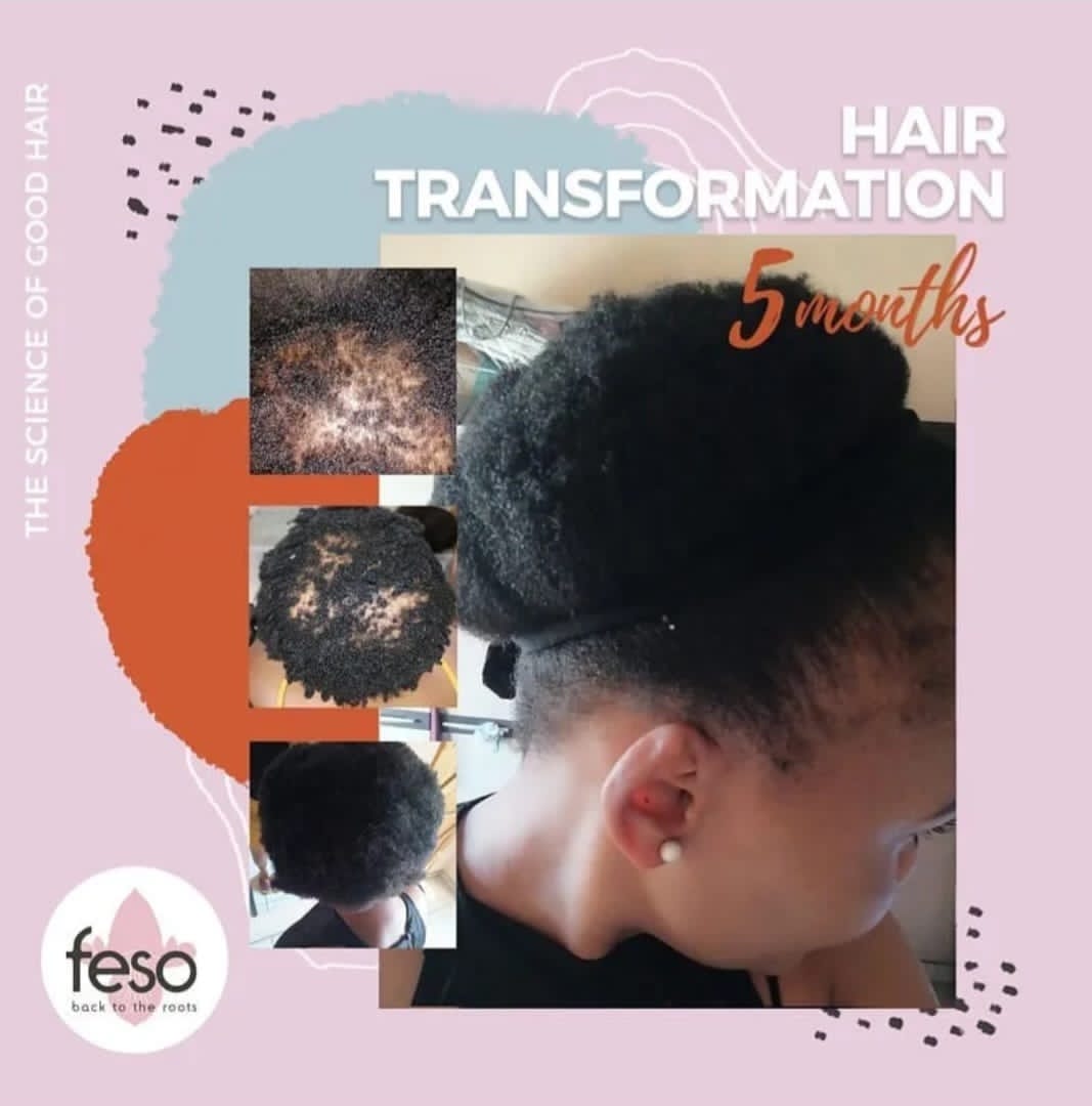 #BREAKING 

Restore your CONFIDENCE

Repair restore your receding hairline

Feso corrective hair products available in pharmarcies in Zimbabwe

Whatsapp+263 772 446 731

RETWEET 🙏
<a href="/cdesetfree/">Setfree Nherera Mafukidze 🇿🇼</a> <a href="/candacy_rutendo/">Candacy Rutendo Gurupira</a> <a href="/runya_gee/">Babes_WekwaZvimba🇿🇼❤️</a> <a href="/Flamisharon/">nursebae</a> <a href="/ANGEZHA_Vauya/">Angezha - Mamoyo Murozvi</a> @ma_vumani <a href="/Mavhure/">Rufaz--Jerera❤King❤</a> <a href="/salloant/">Sokobae ❤️</a>