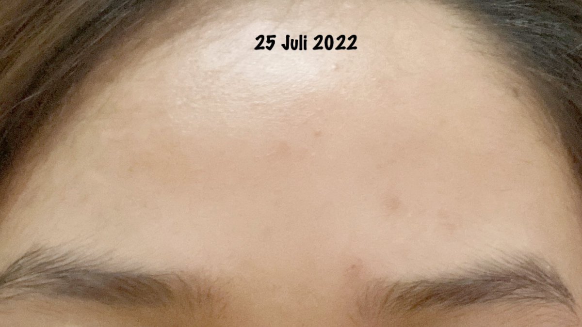 maevemabell's tweet photo. ✨ Menghilangkan Bruntusan Di Dahi Kurang Dari Sebulan ✨

Pemakaian pribadi, honest review

-A Thread- https://t.co/3he2YDrRYO