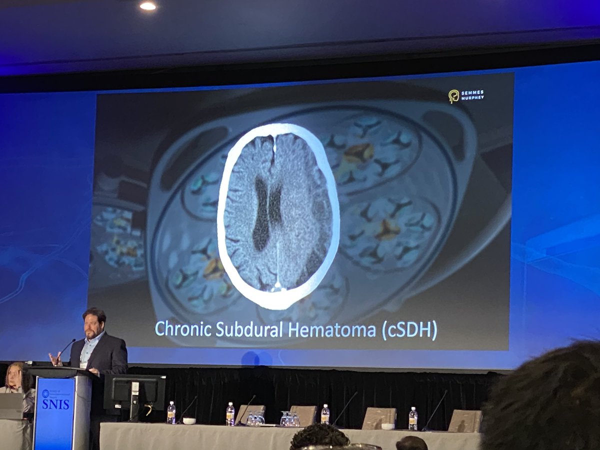 Jeremy Heit, MD, PhD (@jeremyheitmdphd) on Twitter photo Chronic subdural hematomas are a vascular disease. Middle meningeal artery embolization as an emerging therapy. <a href="/AdamArthurMD/">Adam Arthur MD MPH</a> <a href="/InoaVioliza/">Violiza Inoa</a> <a href="/Doctorjfred/">Justin F. Fraser, MD</a> <a href="/MVJayaraman/">Mahesh Jayaraman MD</a> <a href="/JanKarlBurkhar1/">Jan-Karl Burkhardt, MD</a> <a href="/SNISinfo/">SNIS Info</a> #SNIS2022 Chronic subdural hematomas are a vascular disease. Middle meningeal artery embolization as an emerging therapy. <a href="/AdamArthurMD/">Adam Arthur MD MPH</a> <a href="/InoaVioliza/">Violiza Inoa</a> <a href="/Doctorjfred/">Justin F. Fraser, MD</a> <a href="/MVJayaraman/">Mahesh Jayaraman MD</a> <a href="/JanKarlBurkhar1/">Jan-Karl Burkhardt, MD</a> <a href="/SNISinfo/">SNIS Info</a> #SNIS2022