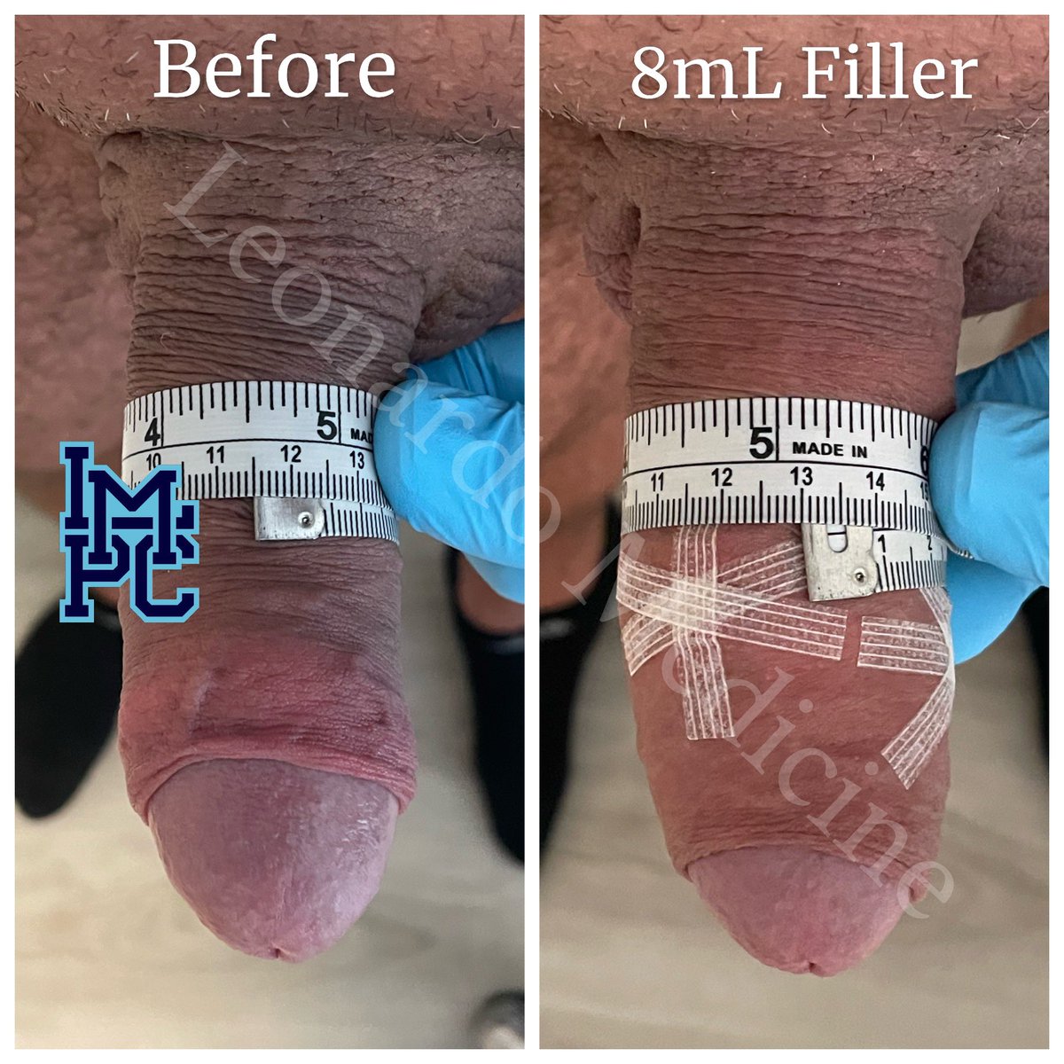 JLeonardoMD's tweet photo. #leonardomedicine #torontoaesthetics #torontomedispa  #menshealth #penileaugmentation #maleenhancement #youonlybigger #penisfiller #maleenhancement #maleaesthetics #glansfiller #prematureejaculationtreatment #malesexualhealth #penileaugmentationtraining
#penileenhancement https://t.co/MxhocDxzSF