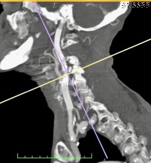 lbncbma's tweet photo. Controle PosOp Angioplastia CCE + Hiperplasia Miointimal CIE #endovascularsurgery #PTA #criticallimbIschemia #thinkaorta  #medtwitter
#practicemakesperfect #vasculartraining #teamvascular #revascularization  #ivus #peripheralarterialdisease #PADdiagnosis #intravascularultrasound https://t.co/wB6uNx8DJW