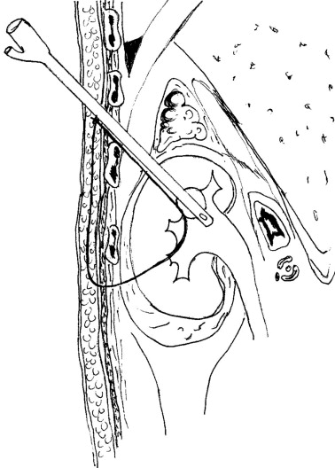 You may have seen the 🧵on nonurologic uses of Foley catheters - head/neck edition (link at the end)....