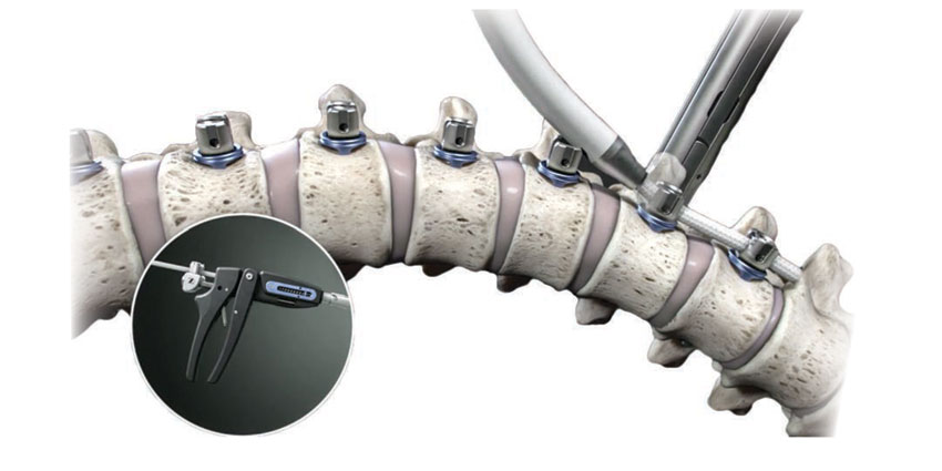 orthothisweek's tweet photo. Anthem, with 42 million health insurance members, just declared vertebral tethering to be ‘medically necessary’. Here are details. https://t.co/Mz95XTBczA 

#AnthemBlueCrossBlueShield #ZimVieSpine #RebeccaWhitney #TheTether #JarenRiley #FDA #otw #orthopedicsthisweek #orthopedics https://t.co/keVK7IdBOm