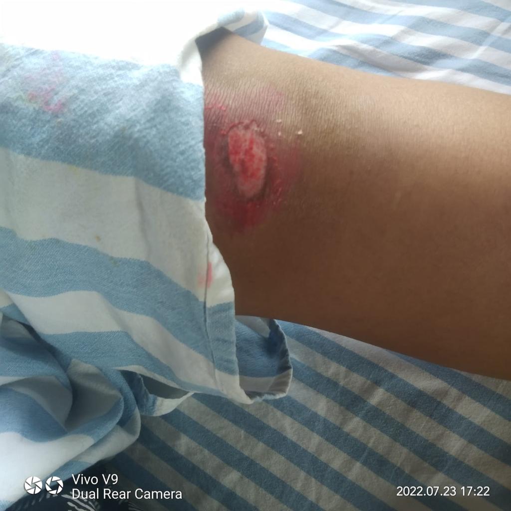 KeypadGuerilla's tweet photo. Due to #pothole a 2nd year MSc student Nishmita broke her arm and is fearful of missing her exam next month in #Mangalore #Karnataka. Nishmita was returning home in her bike when she skidded at Nethravathi brigde (highway no 66) due to a pothole in the middle of the road (1/2) https://t.co/280iTjLMtj