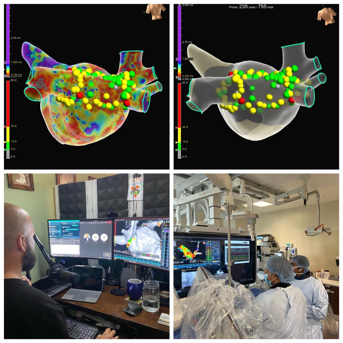 100% remotely supported case in Houston, Texas from 90 miles away! Via Ensite Connect, persistent PVI mapped and ablated over secure, HIPAA compliant connection. Amazing what technology can do! #EPeeps #EnsiteX #HDGrid #Ensiteconnect #epheart #cardiotwitter #pvi #uthealth