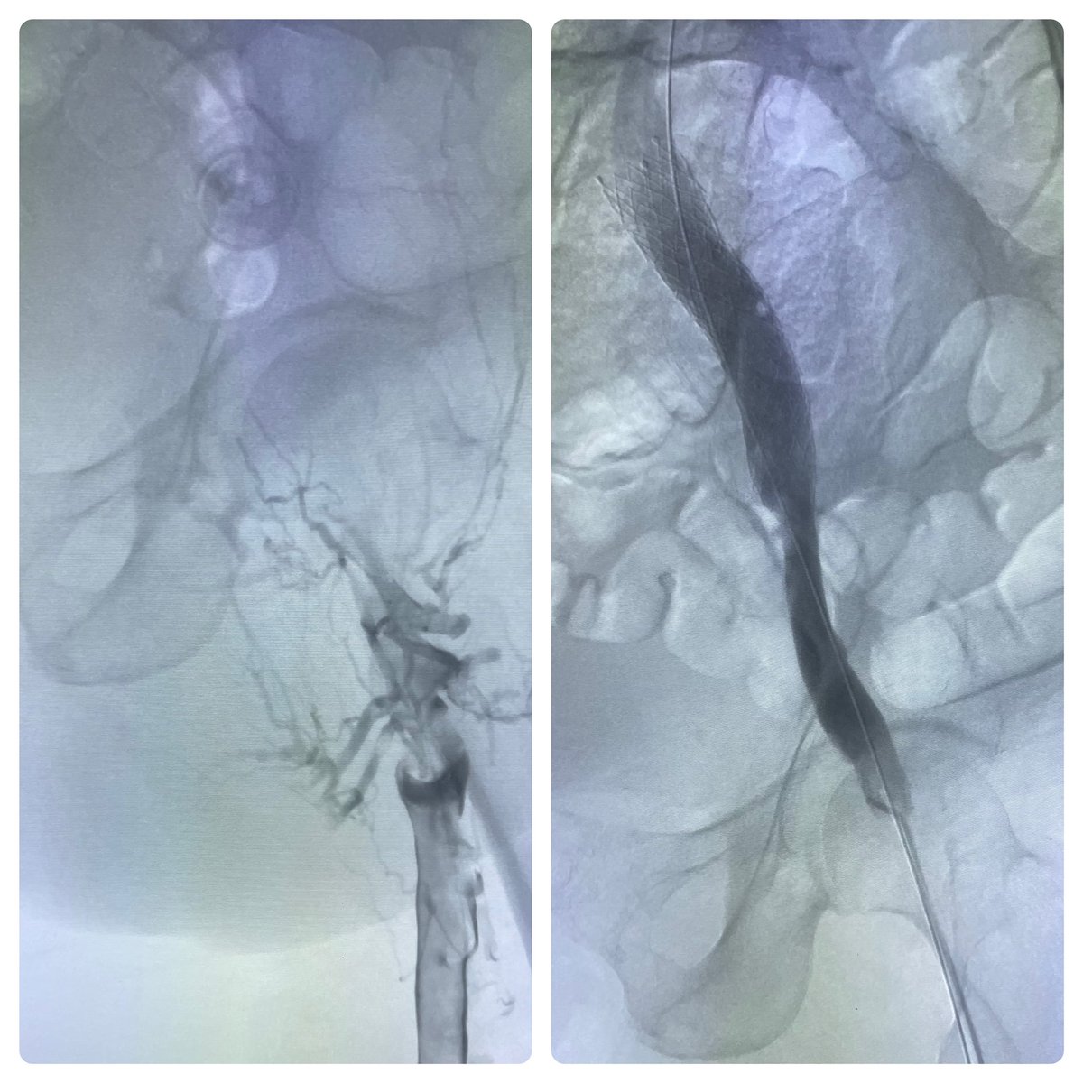 joeliechty's tweet photo. Acute extensive left leg DVT- treated in about an hour with Inari ClotTriever and Medtronic Abre. Great case! #inari #dvt #medtronic https://t.co/xOjcuo7Svt