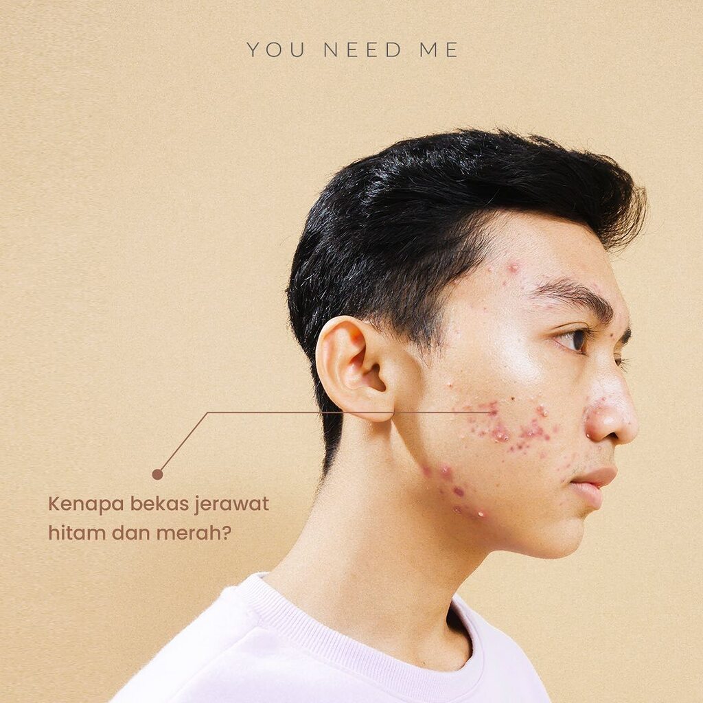 youneedme_id's tweet photo. GIMANA SIH ATASI ACNE SCARS

Acne scars dapat kita atasi dengan inggridients yg berfungsi mencerahkan, seperti vitamin c, alpha arbutin, niacinamide, dan masih banyak lagi inggrisients yang berguna untuk memperbaiki acne scars

Sayangnya beberapa inggridietns ini dapat memic… https://t.co/e5Hhl9lZLy