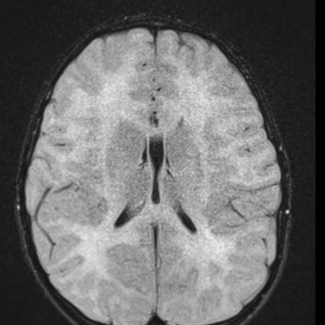 NeuroimagingN's tweet photo. Hypomyelinating (dysmyelinating) leukodystrophy. Unknown mutated gene. 

#Leukodystrophy #hypomyelinatingdisease #myelin #pediatricneurology #neurology #neuroradiology #radiology #NeuroTwitter #MedEd https://t.co/cNLxkMTRKx