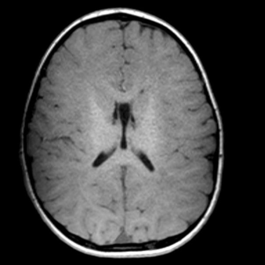 Hypomyelinating (dysmyelinating) leukodystrophy. Unknown mutated gene. 

#Leukodystrophy #hypomyelinatingdisease #myelin #pediatricneurology #neurology #neuroradiology #radiology #NeuroTwitter #MedEd