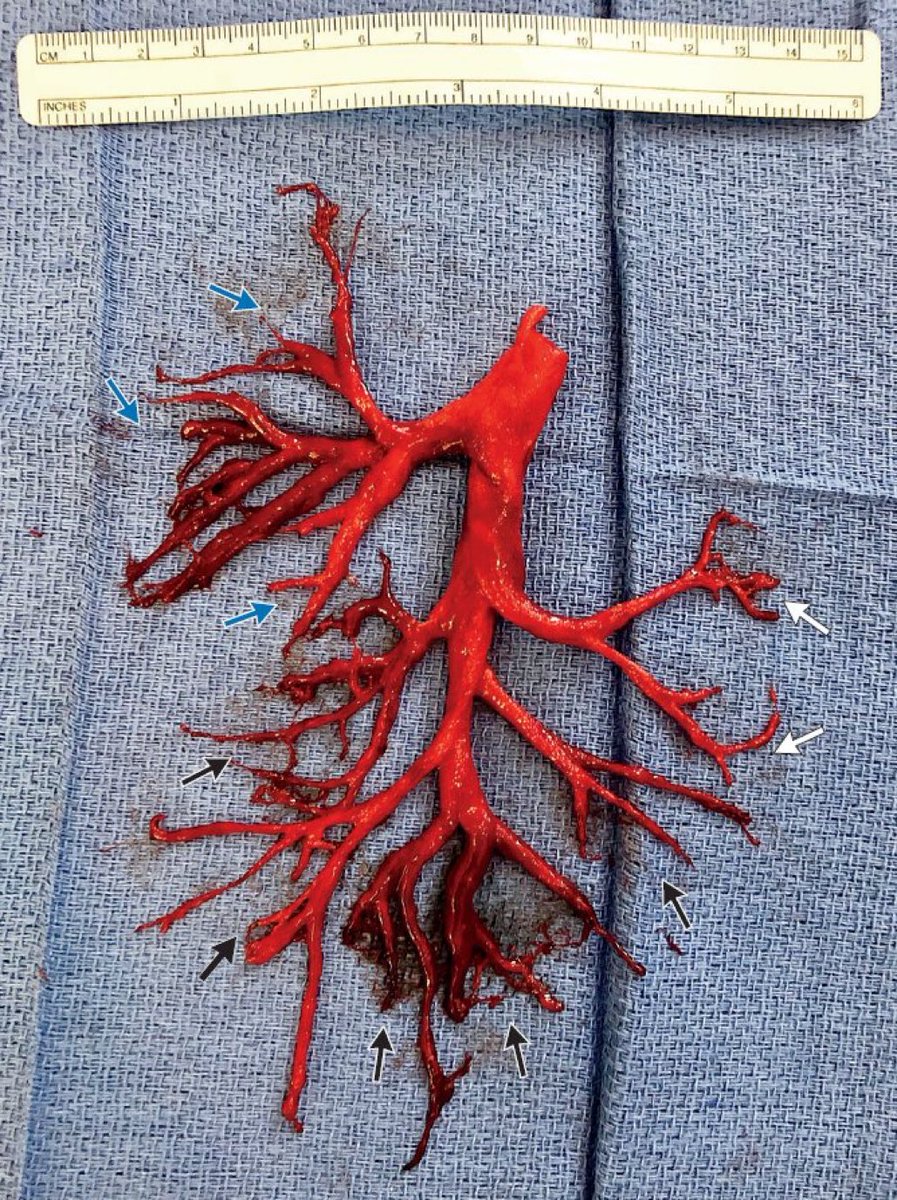 A person actually managed to cough up this cast of the right bronchial tree 🤯

#MedTwitter