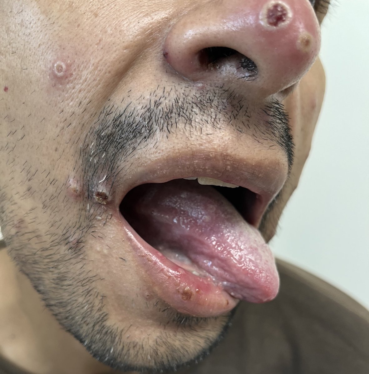 JeronimoHiram's tweet photo. Px HSH adulto joven con 4 días de sintomatología caracterizada por mialgias, fiebre no cuantificada, ataque al estado general y exantema en diferentes estadios. En la EF Adenopatías cervicales posteriores:Caso probable de #monkeypox (fotos tomadas con autorización del paciente). https://t.co/DzndIX2C3K