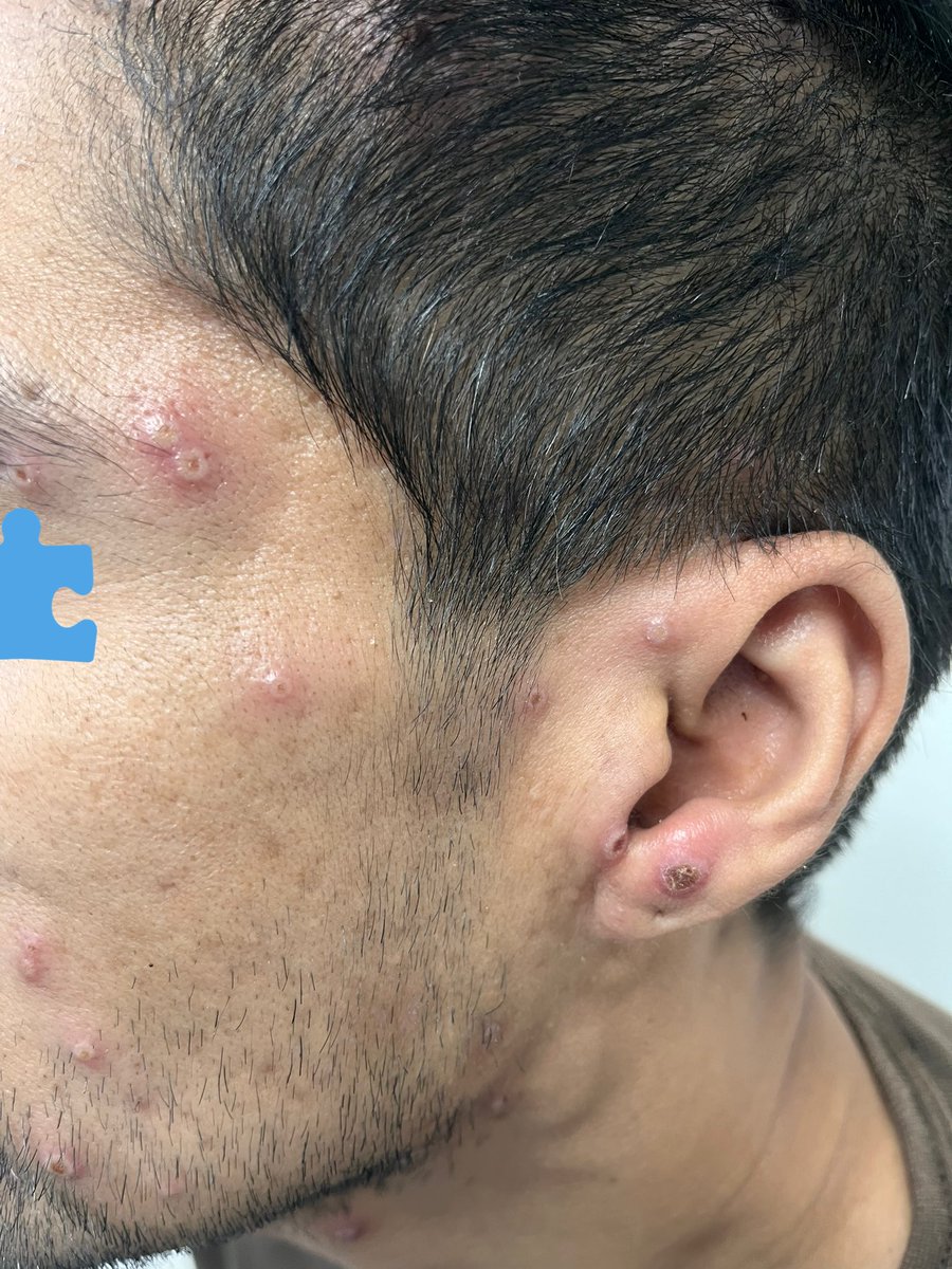 JeronimoHiram's tweet photo. Px HSH adulto joven con 4 días de sintomatología caracterizada por mialgias, fiebre no cuantificada, ataque al estado general y exantema en diferentes estadios. En la EF Adenopatías cervicales posteriores:Caso probable de #monkeypox (fotos tomadas con autorización del paciente). https://t.co/DzndIX2C3K