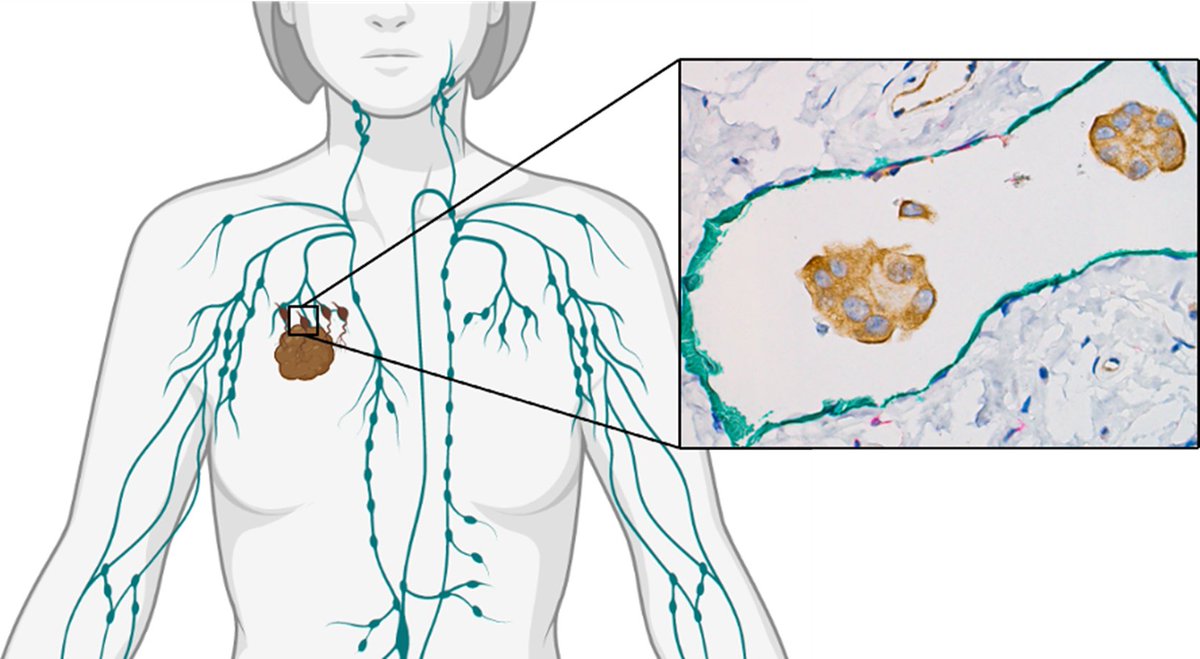 Journal of Mammary Gland Biology and Neoplasia (@mammary_journal) on Twitter photo 📢 Call for papers 📢 Special issue on The #lymphatic system in #mammarygland biology and cancer is in preparation! Guest Edited by <a href="/tracirlyons/">Traci Lyons</a> and <a href="/EstaSterneck/">Esta Sterneck</a>
springer.com/journal/10911/… 📢 Call for papers 📢 Special issue on The #lymphatic system in #mammarygland biology and cancer is in preparation! Guest Edited by <a href="/tracirlyons/">Traci Lyons</a> and <a href="/EstaSterneck/">Esta Sterneck</a>
springer.com/journal/10911/…