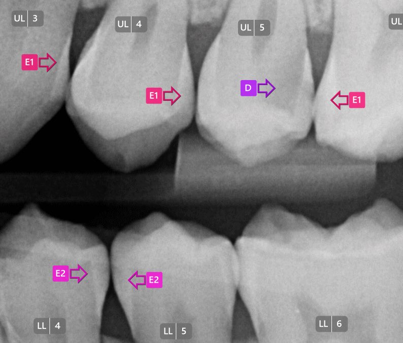 Really proud of the team for the new release of <a href="/AssistDent/">Manchester Imaging Limited</a> V2.

The new improved platform includes: improved caries detection, caries grading - E1/E2 &amp; D (Dentine) and auto- tooth labelling e.g. UR.6