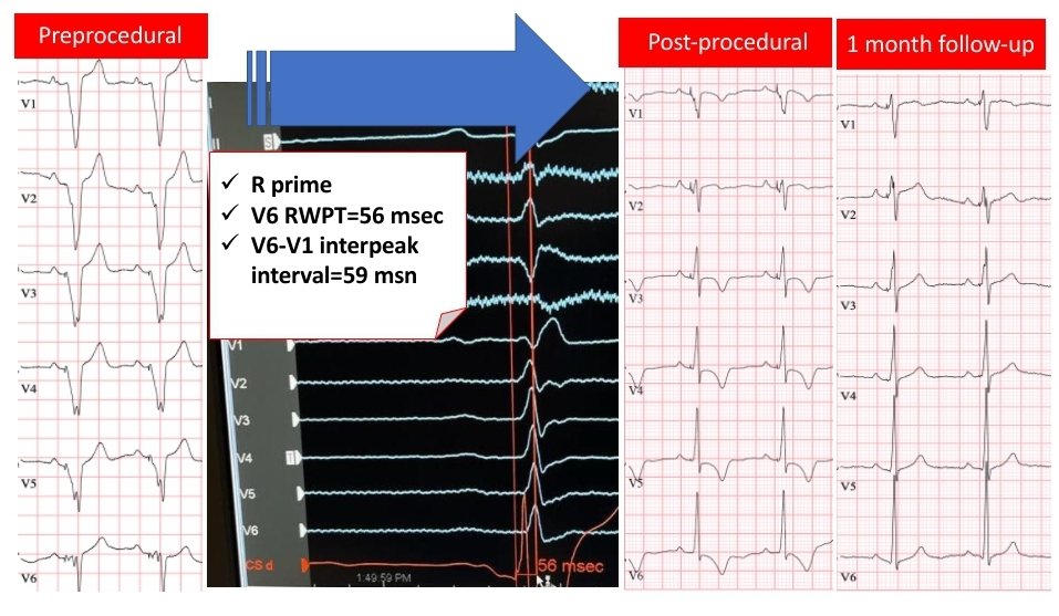 Can LBBP be the first choice for young patients? We have prioritized LBBP,the outcomes are encouraging.Our patient was congenital heart block with pacemaker since 2007. After LBBP, LVEF improved from 46% to 58% @drtopaloglu @DursunAras2 @MdHuang @Hisdoc1 @Marek_Jastrz_EP