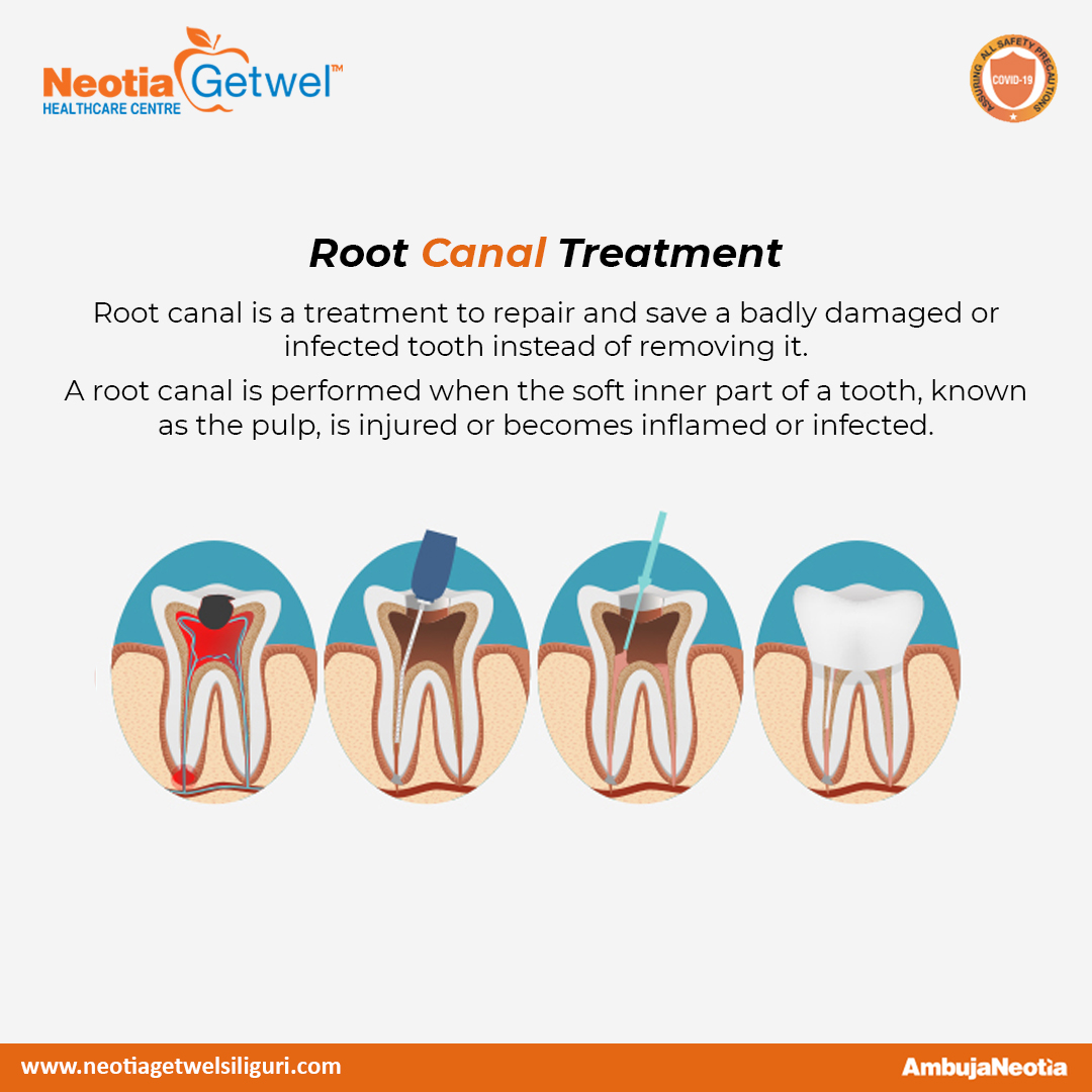 ngmh_official's tweet photo. With dental advances and local anaesthetics, most people have little if any pain during a root canal.
Department of Dentistry at #Neotia Getwel Healthcare Centre comprises an expert team of dentists professionally trained in performing a wide range of general #dental procedures https://t.co/D3iJn9WQtu