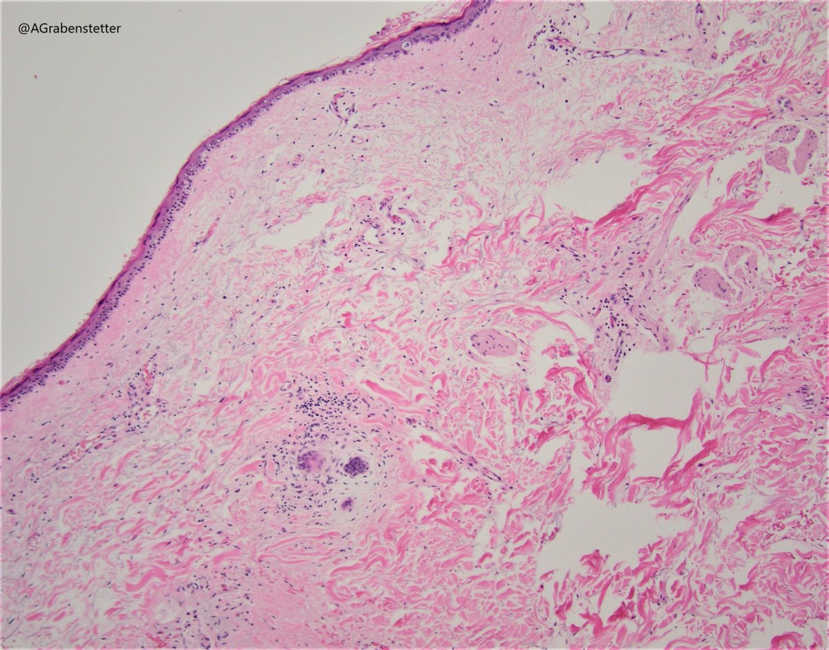 AGrabenstetter's tweet photo. A lesson in why a complete clinical history is essential🧵#pathtwitter #MedTwitter #bcsm 

Requisition: 74 y.o. ♀️ with left breast calcifications 

Imaging report: Ca++ in posterior third of breast, UIQ

Initial sections: skin and fat, no Ca++, no breast tissue https://t.co/9bcxmQ0qfh