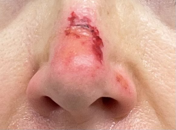 TrishaSanders33's tweet photo. Didn’t know sunburns would bleed! 😱...😳...🥺...😢...😧 https://t.co/9c8pjDtlGZ