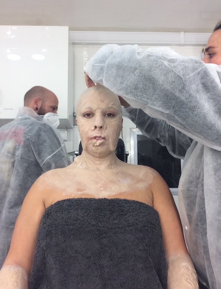 7. Becoming #MotherZero. Forehead and second bald cap on. #ResidentEvil #ResidentEvilNetflix #practicalfx #prosthetics