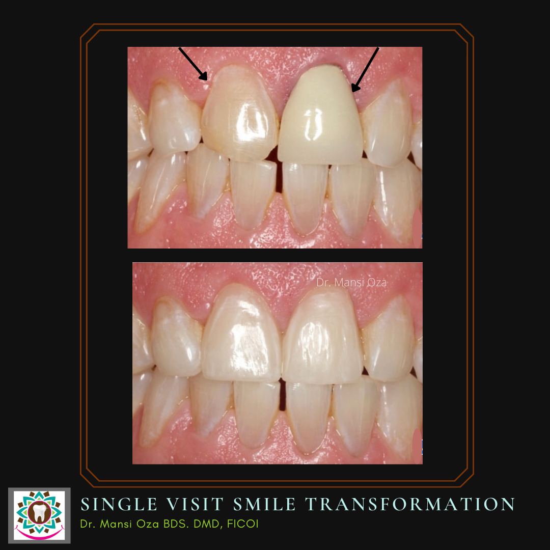 Cosmetic dentistry doesn't have to look fake. We can totally achieve a smile exactly how you want it.
.
Do your front teeth make you feel self conscious? Do you have old crowns that show a black line in the gums? We can achieve very natural results for you in just one visit (base