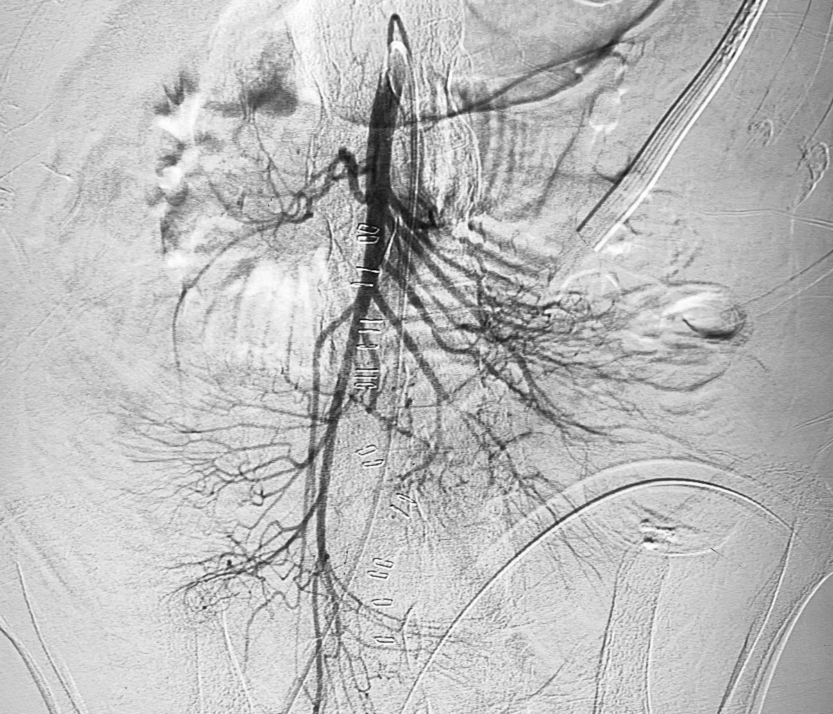 Dr Ajit Yadav (@drajityadav) on Twitter photo Two Different bleeder one Embolizing agent - GLUE
1st Liver abscess post drainage PSA
2nd Jejunal Ulcer Bleed
Glue is best agent for active bleed
<a href="/ELEC_radiology/">European Liquid Embolic Course</a> <a href="/draditichauras1/">Aditi Chaurasia</a> <a href="/SIRRFS/">SIR RFS</a> @IR_juniors <a href="/ISVIRIndia/">ISVIR India</a> <a href="/RajNarayanan67/">Raj Narayanan</a> <a href="/thegestgroup/">GEST -Global Embolization Symposium & Technologies</a> <a href="/drgauravgangwni/">Dr. Gaurav Gangwani (Interventional Radiologist)</a> <a href="/paragpatel_IR/">Parag Patel</a> Two Different bleeder one Embolizing agent - GLUE
1st Liver abscess post drainage PSA
2nd Jejunal Ulcer Bleed
Glue is best agent for active bleed
<a href="/ELEC_radiology/">European Liquid Embolic Course</a> <a href="/draditichauras1/">Aditi Chaurasia</a> <a href="/SIRRFS/">SIR RFS</a> @IR_juniors <a href="/ISVIRIndia/">ISVIR India</a> <a href="/RajNarayanan67/">Raj Narayanan</a> <a href="/thegestgroup/">GEST -Global Embolization Symposium & Technologies</a> <a href="/drgauravgangwni/">Dr. Gaurav Gangwani (Interventional Radiologist)</a> <a href="/paragpatel_IR/">Parag Patel</a>