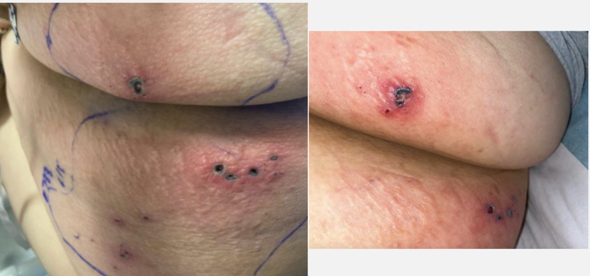 #idboardreview A middle-aged neutropenic woman w/ luxeptinib therapy for follicular lymphoma w/ nausea, diarrhea, abd pain x 2 weeks. R elbow, abdomen, L flank skin lesions, pictured below. DDx? Thoughts?

#medid #MedEd #IDtwitter #idboards