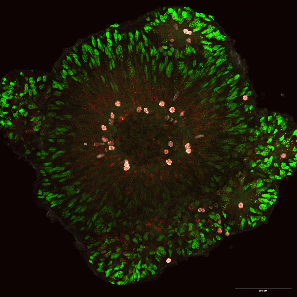 brooke latour (@blalatour) on Twitter photo I am excited & honored to join the <a href="/KdVSFoundation/">KdVS Foundation</a> for a webinar tomorrow (Wed, 2 PM Eastern Time / 8 PM CET) where we will discuss my research from the @naelnadif lab on modeling KdVS in cerebral organoids. Registration is possible via this link: us02web.zoom.us/webinar/regist… I am excited & honored to join the <a href="/KdVSFoundation/">KdVS Foundation</a> for a webinar tomorrow (Wed, 2 PM Eastern Time / 8 PM CET) where we will discuss my research from the @naelnadif lab on modeling KdVS in cerebral organoids. Registration is possible via this link: us02web.zoom.us/webinar/regist…