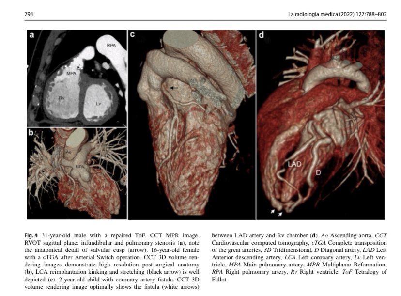 cardiopedhnn's tweet image. Recomendaciones para #whyCCT y #yesCMR en #cardiopatia_congenita

doi.org/10.1007/s11547…

#CHD #ACHD