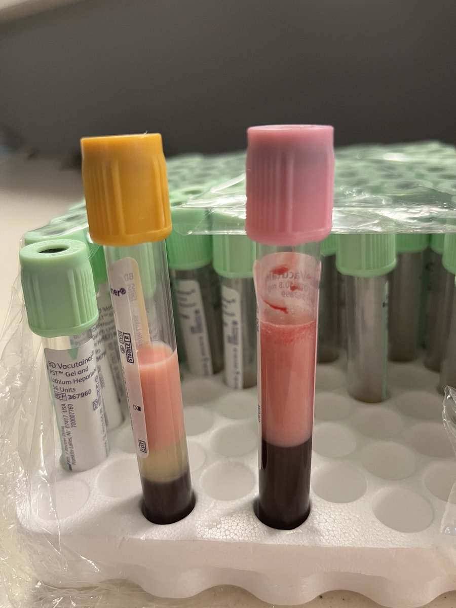 KurteL10's tweet photo. Classic finding. What’s the likely ER presenting diagnosis? https://t.co/PfHTCfDiTV