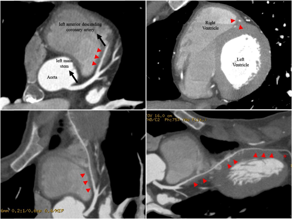 andrefalexandre's tweet photo. Myocardial Bridging Leading to Cardiac Collapse in a Marathon Runner https://t.co/U1Sv07e4Np #mdpijcdd via @JCDD_MDPI 

#myocardial #bridging
#exertional #syncope
#marathon #running
#CCTA #strain https://t.co/hQUaOct6C0