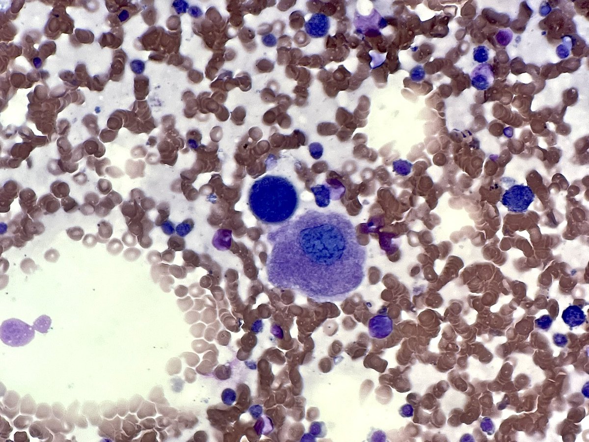 NanaMatsumoto8's tweet photo. 👀 Isn’t it amazing when they follow the books? #hemepath #PathTwitter #hematology https://t.co/sYLcB2ewsv