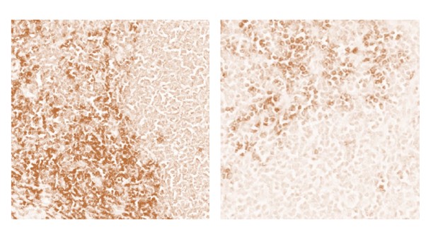 ParheliaBio's tweet photo. Ready to optimize your #IHC staining?
#Parheliabio thin layer staining reduces high background making positive populations easier to detect.
Pic: Manual CD8 staining in human FFPE tissue with high background on the left vs automated staining on the right.

Seeing is believing! https://t.co/2dVDuTdA81