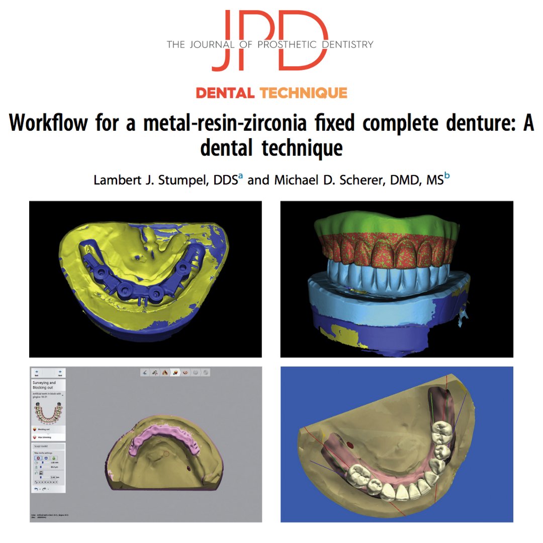 JPDentistry's tweet photo. This #dentaltechnique combines #digitalworfklow #completedenture with analog procedures to fabricate a fixed #implantprosthesis with zirconia and #3Dprinted resin at reduced effort and cost. Learn more: https://t.co/4WxsgpT6uQ https://t.co/Mwnr9vuFrs