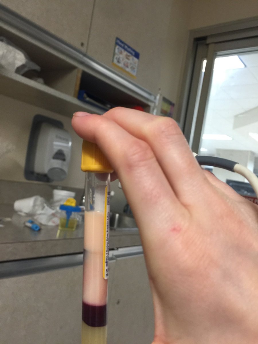 WhitneyHerrigPA's tweet image. Here’s my “blood” from 5 years ago with trigs 10K+ landing me in the ICU with pancreatitis. Think I win 😝 No but seriously kidding aside that fucking sucked.