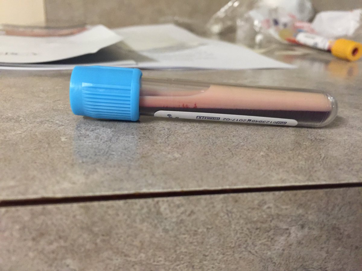 WhitneyHerrigPA's tweet image. Here’s my “blood” from 5 years ago with trigs 10K+ landing me in the ICU with pancreatitis. Think I win 😝 No but seriously kidding aside that fucking sucked.