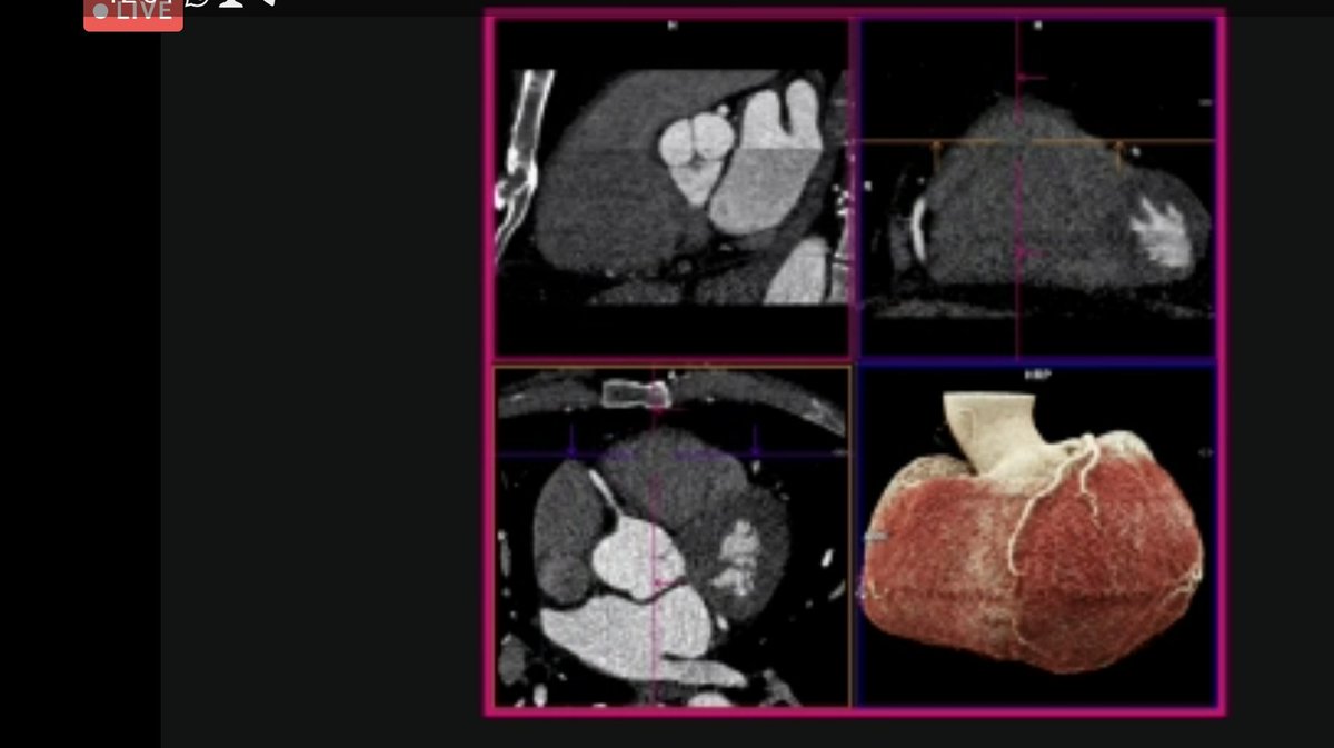 ayazhidayetov's tweet image. What a superb talk on Cardiac CT from Ben Hudson as part of #Radiopaedia2022
Amazing and detailed explanation.
#radiopaedia #radiology #cardiacct