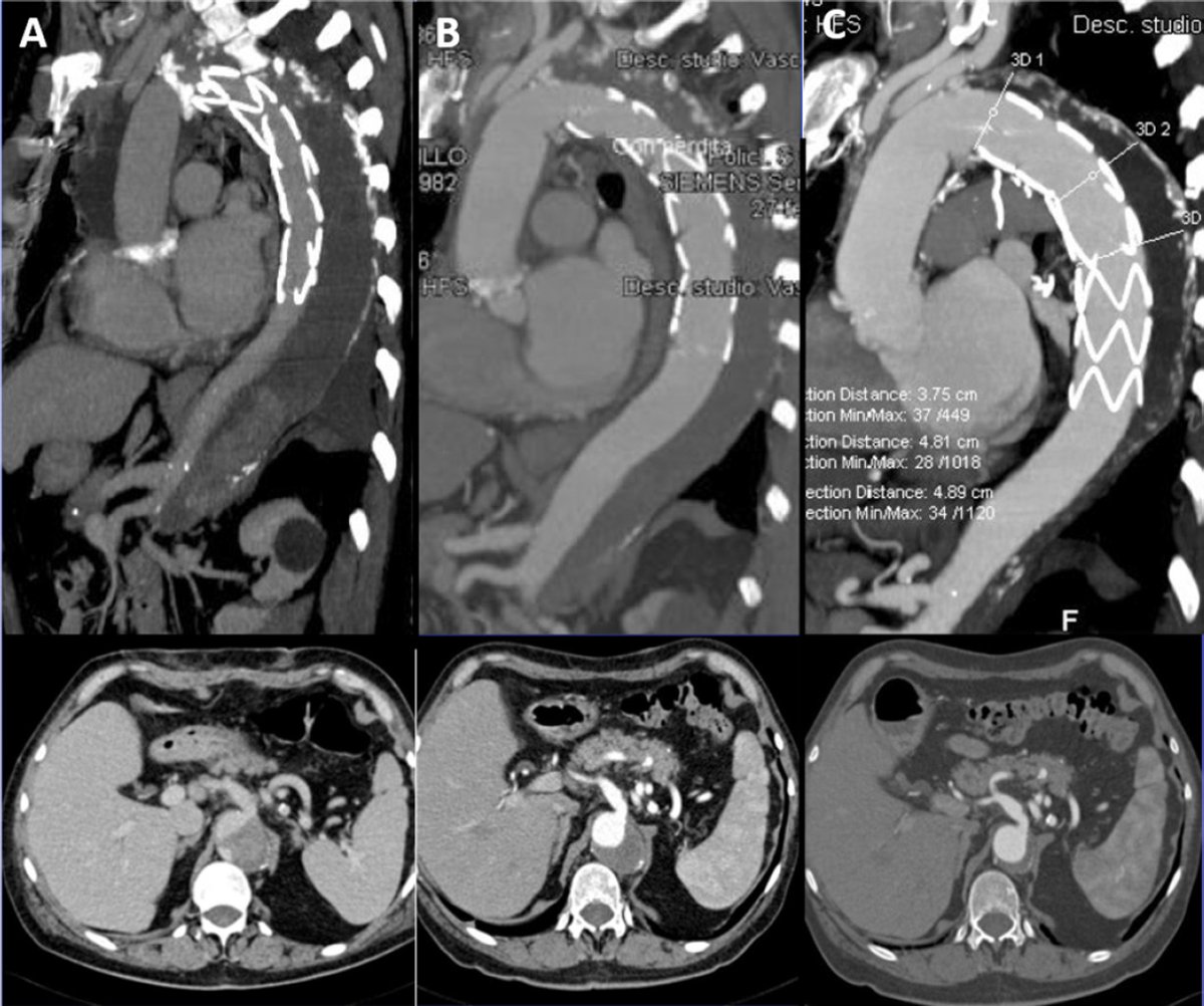 Vessel_Plus's tweet photo. #FET #AcuteAorticDissection
📝Dr. Luca Di Marco and Prof. Davide Pacini et al from Bologna University introduced the #Frozen #elephant #trunk technique and their opinions and recommendations based on their experience started in #2007.👍
📖https://t.co/Jc86Kn3Lfx https://t.co/acnug0nL5y