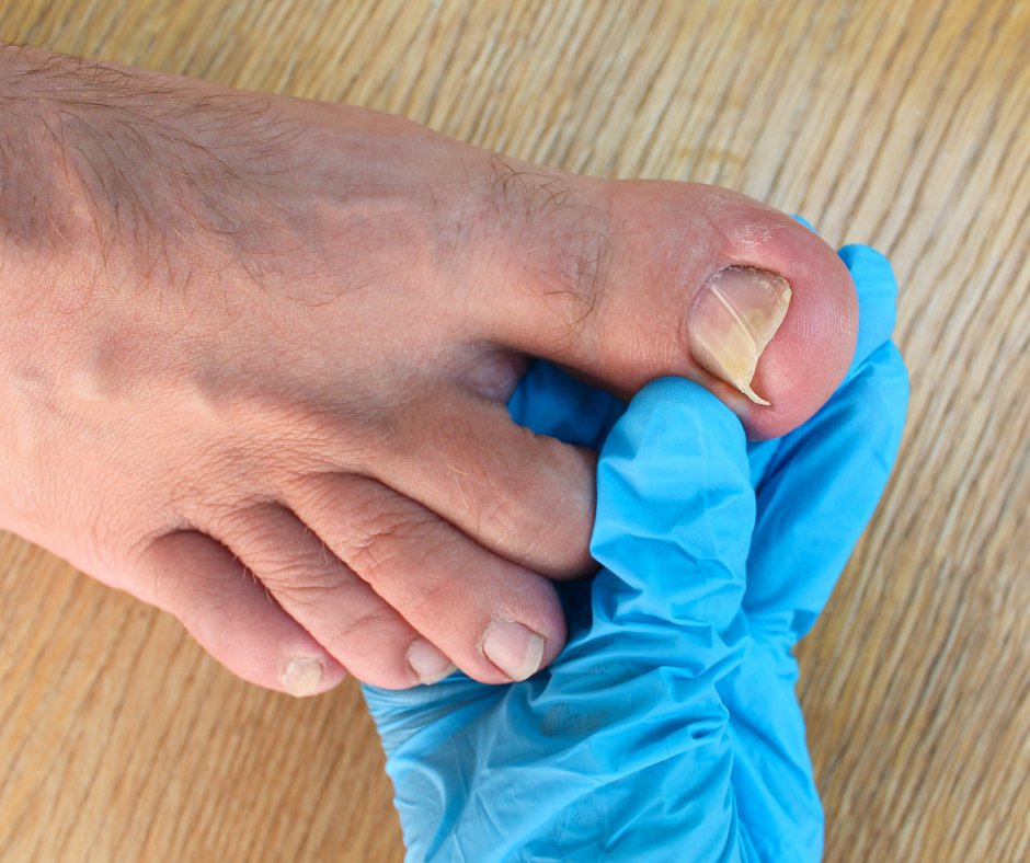 #Ingrowntoenails are common, especially among #teenagers and #youngadults. In fact, 20 out of 100 people who see their #podiatrist have an ingrown toenail. Today, #DrAnthonyWeinert is sharing information about #onyfix, a treatment: bit.ly/3qqUidG

#podiatristTroyMI